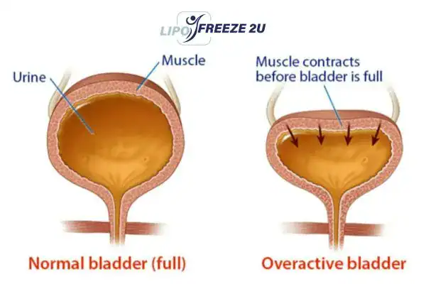 diagram of overactive bladder treatment Alton