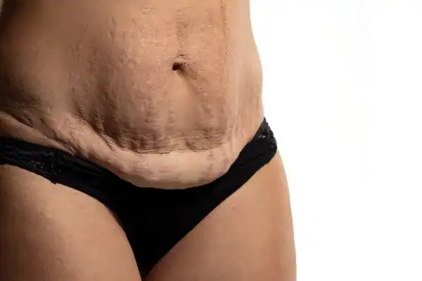 loose skin after weight loss injections Alton