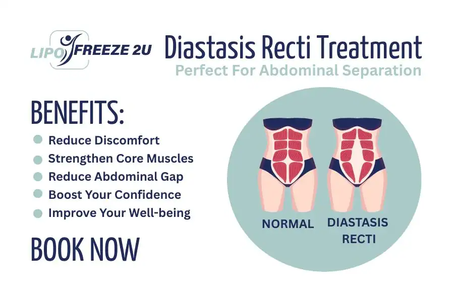 Benefits of body toning treatment Alton for Diastasis recti