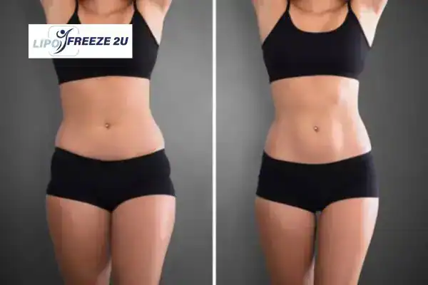 How Can LIPO FREEZE 2U Support Your Post-Pregnancy Body Recovery Alton?