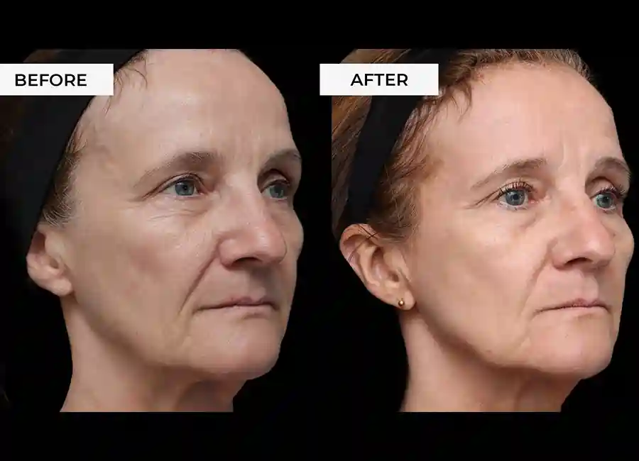 How Many RF Microneedling Sessions Will You Need to See a Difference Alton?