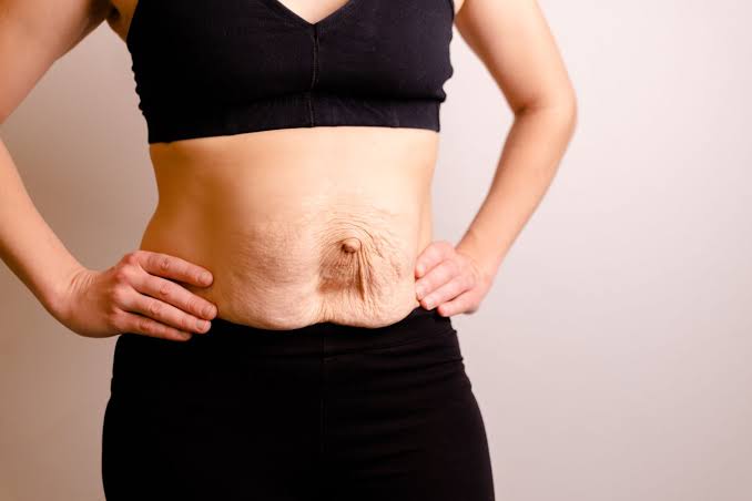 Is Surgery Really the Only Way to Repair Diastasis Recti Alton?