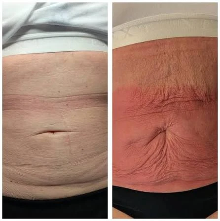 How Does RF Microneedling Improve Crepey, Thin and Uneven Skin Texture Alton?