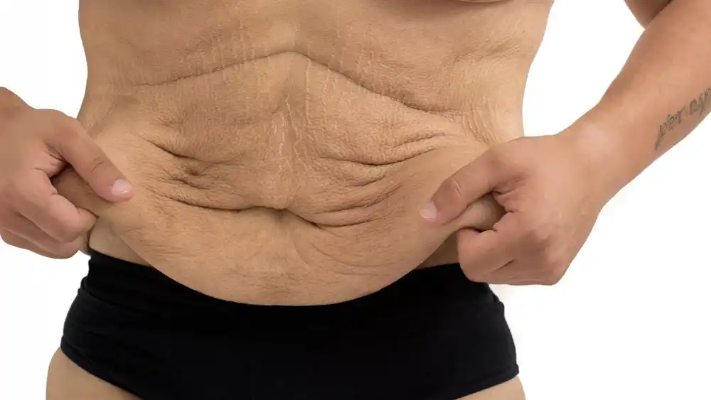 RF Microneedling for Loose Skin: How Can It Help Tighten and Reshape the Skin Alton?